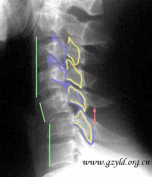 disloca2_1s.jpg (14950 bytes)