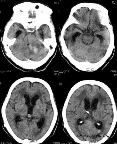 hydrocephalus1.jpg (67328 bytes)