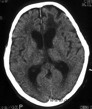 old front infarct.jpg (25590 bytes)