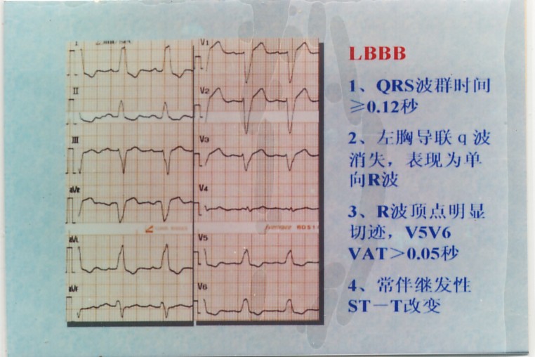 ֧LBBB